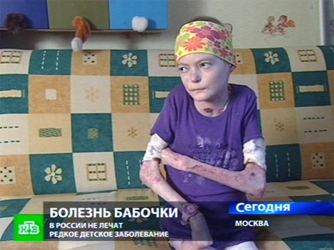 Что с девочкой у которой кожа бабочки Что с девочкой у которой кожа бабочки