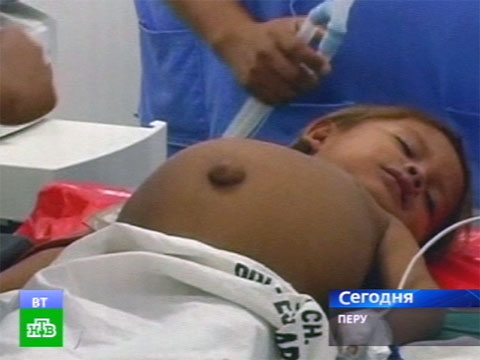 Видеоновость: В животе мальчика нашли близнеца-паразита
