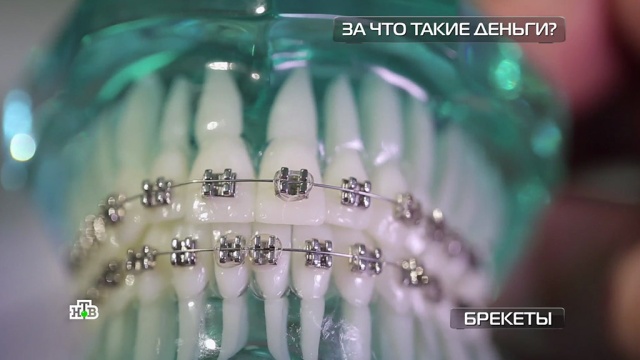 Брекеты наружные против внутренних: чего стоят комфорт и красота.
здоровье, стоматология, технологии.
НТВ.Ru: новости, видео, программы телеканала НТВ Брекеты наружные против внутренних: чего стоят комфорт и красота.
здоровье, стоматология, технологии.
НТВ.Ru: новости, видео, программы телеканала НТВ
