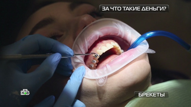 Брекеты наружные против внутренних: чего стоят комфорт и красота.
здоровье, стоматология, технологии.
НТВ.Ru: новости, видео, программы телеканала НТВ Брекеты наружные против внутренних: чего стоят комфорт и красота.
здоровье, стоматология, технологии.
НТВ.Ru: новости, видео, программы телеканала НТВ