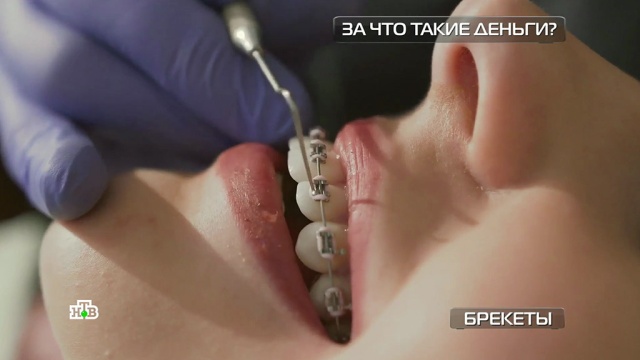 Брекеты наружные против внутренних: чего стоят комфорт и красота.
здоровье, стоматология, технологии.
НТВ.Ru: новости, видео, программы телеканала НТВ Брекеты наружные против внутренних: чего стоят комфорт и красота.
здоровье, стоматология, технологии.
НТВ.Ru: новости, видео, программы телеканала НТВ
