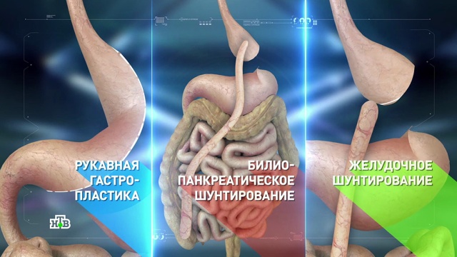 Красота требует жертв: зачем удалять желудок ради похудения.
лишний вес/диеты/похудение.
НТВ.Ru: новости, видео, программы телеканала НТВ Красота требует жертв: зачем удалять желудок ради похудения.
лишний вес/диеты/похудение.
НТВ.Ru: новости, видео, программы телеканала НТВ